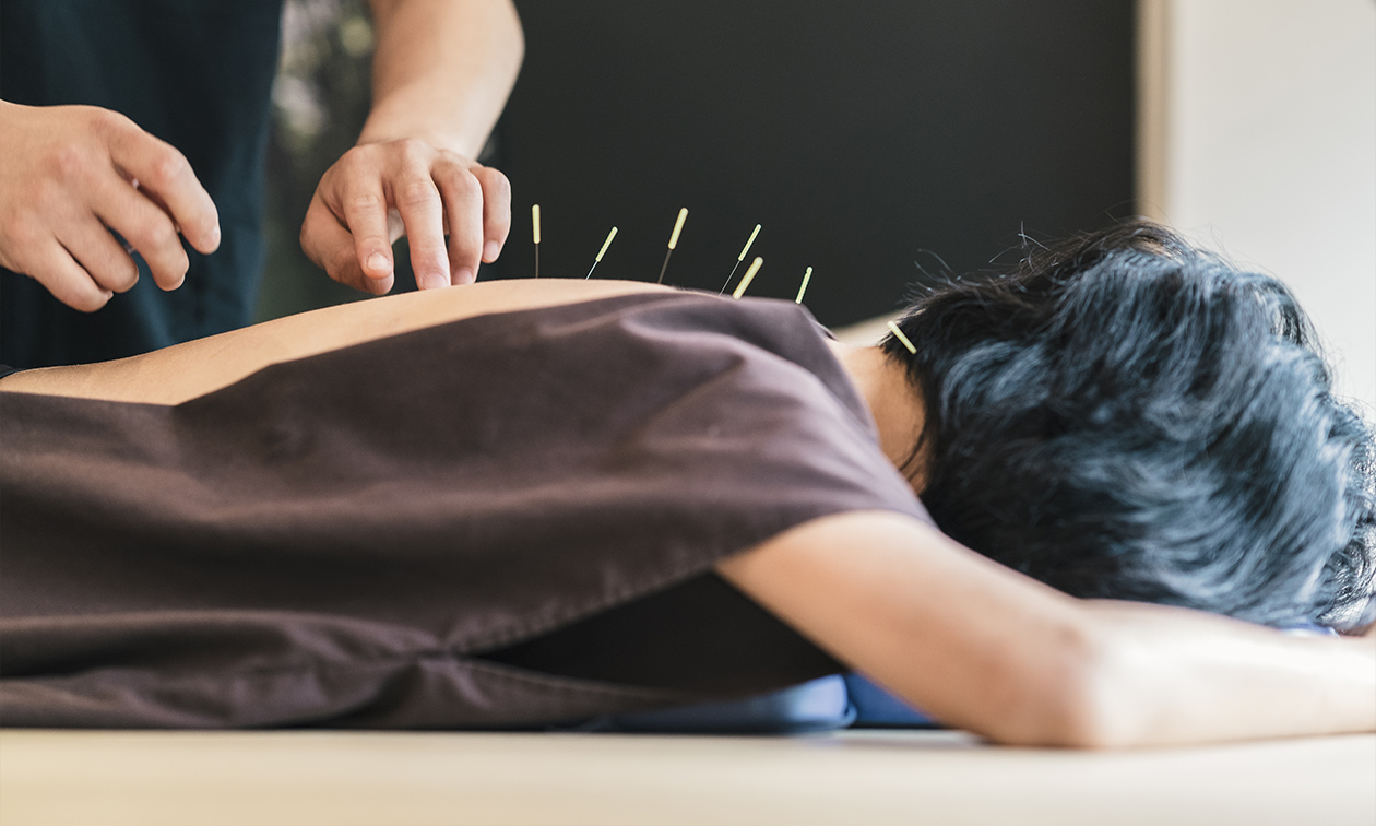 Acupunctuur Vernimmen