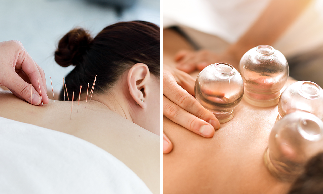 Cuppingmassage of 1, 3 of 5 acupunctuurbehandeling(en)