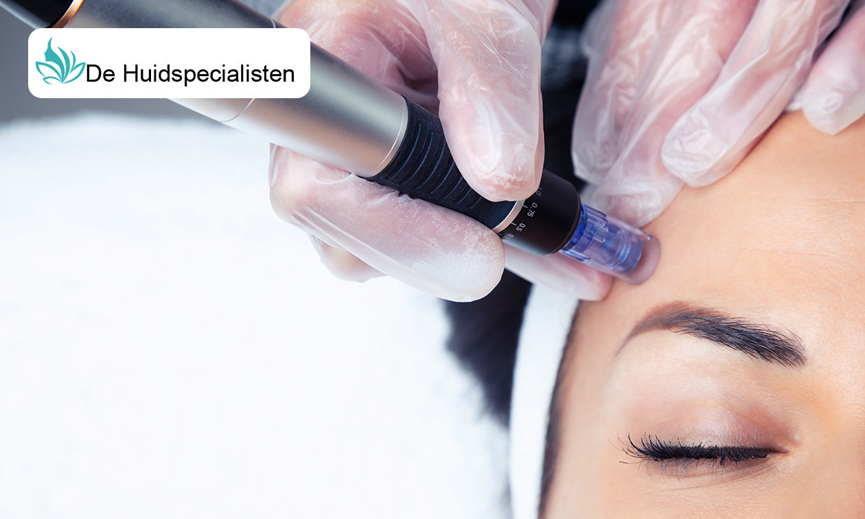 1, 4 of 6 basis of luxe microneedling-behandeling(en) of lipbooster-behandeling