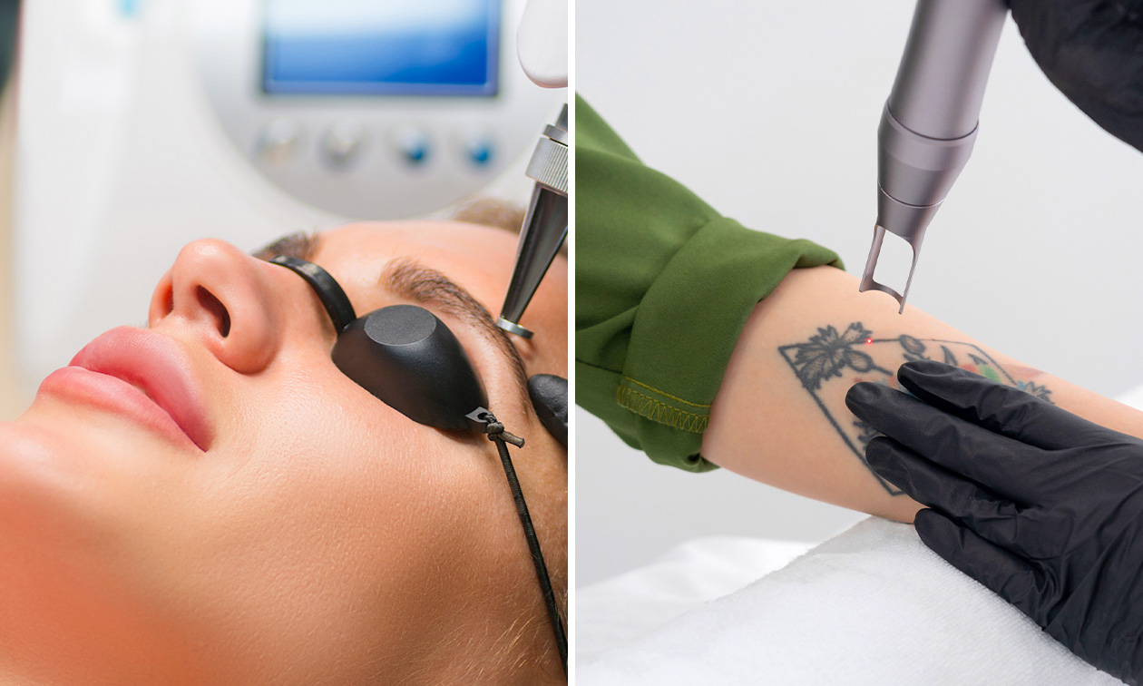 Tatoeage of PMU verwijderen