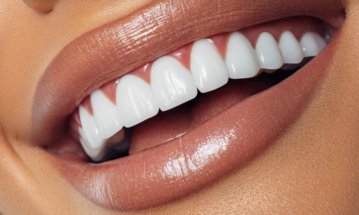 3 of 5 tandenbleekbehandeling(en) of 1 nabehandeling